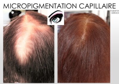 solution alopecie femme, solution perte de cheveux femme, micropigmentation du crane, ,imes, montpellier, arles, avignon, alès ysabel marignan
