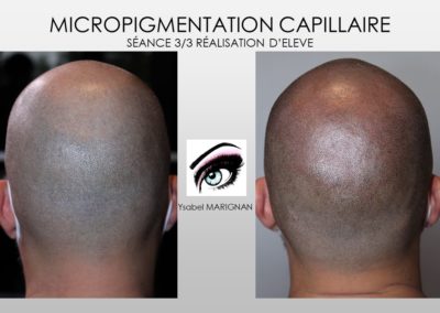 SMP.Micropigmentation du cuir chevelu, camouflage cicatrice d'implant nimes marseille montpellier
