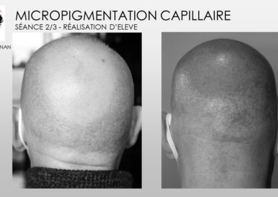 SMP.Micropigmentation du cuir chevelu, camouflage cicatrice d'implant nimes marseille montpellier
