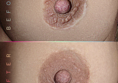 cicatrices d'implants mammaires nimes dermopigmentation, paris lyon marseille