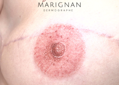 tatouage de la plaque aréolo-mammelonaire,aréole 3D, dermopigmentation des aréoles nimes montpellier, marseille