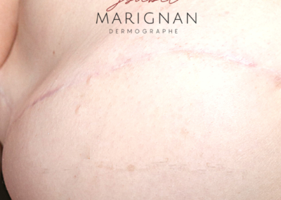 tatouage de la plaque aréolo-mammelonaire,aréole 3D, dermopigmentation des aréoles nimes montpellier, marseille