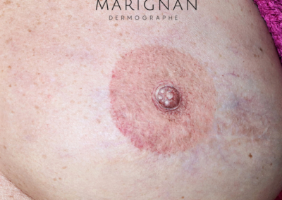 areole post mastectomie post cancer tatouage nîmes,paris,lyon
