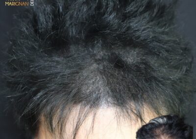 tricopigmentation densification cheveux