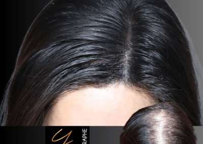 tricopigmentation solution alopecie nimes montpellier avignon