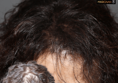 densification alopecie femme