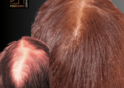 alopecie femme nimes tricopigmentation