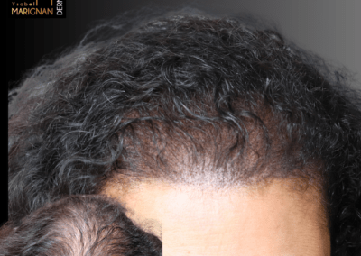 alopecie femme solution par densification nimes tricopigmentation nimes montpellier lyon paris