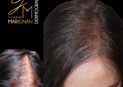 smp, tricopigmentation ,nimes,montpellier, alopecie