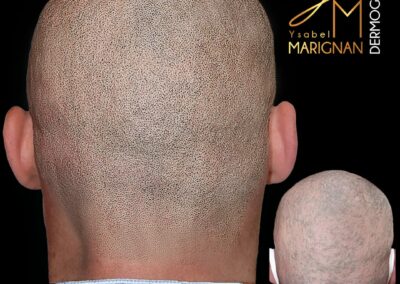 smp, tricopigmentation ,nimes,montpellier, alopecie